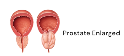 FAQ about Prostate and Answered By Dr Ghanendra Kumar Yadav (Urologist in Drgkurologist)